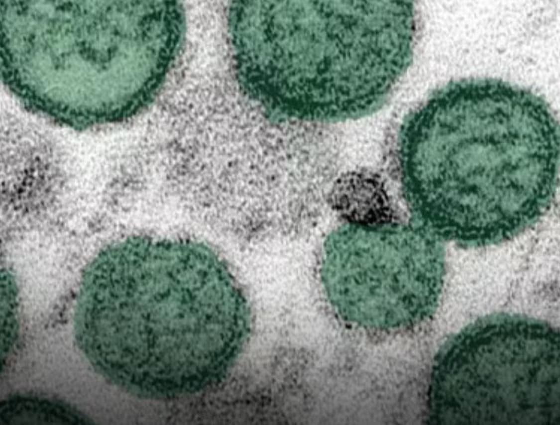 Hantavirus-302704